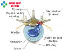 Thoát vị đĩa đệm là gì? Tìm hiểu nguyên nhân, triệu chứng và cách điều trị